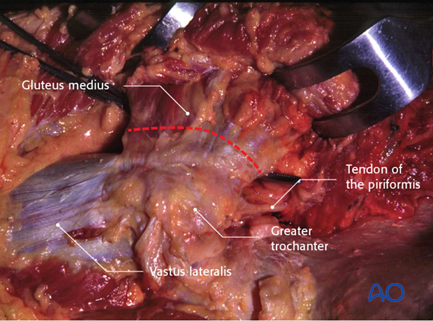 extended iliofemoral approach to the acetabulum