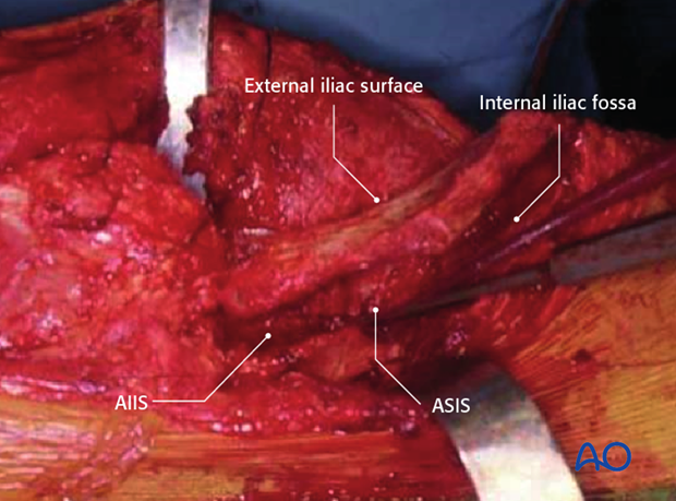 extended iliofemoral approach to the acetabulum