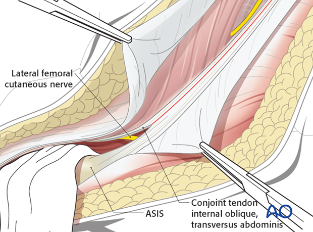 ilioinguinal approach to the acetabulum