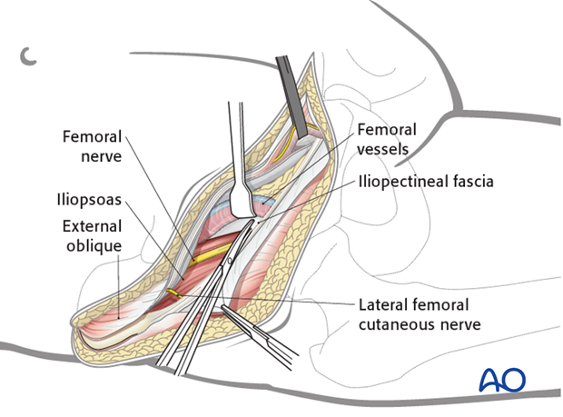 ilioinguinal approach to the acetabulum