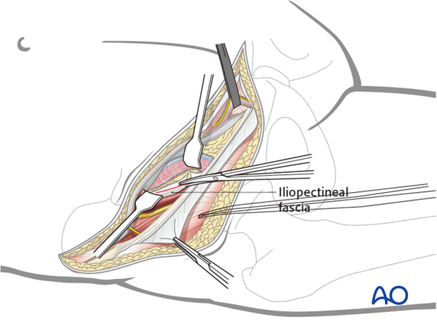 ilioinguinal approach to the acetabulum