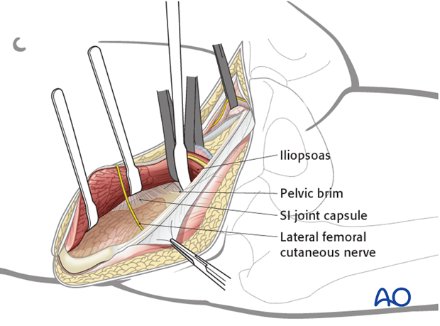 ilioinguinal approach to the acetabulum