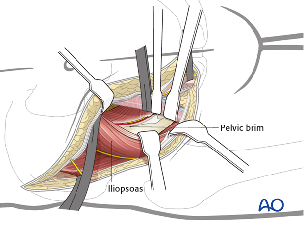 ilioinguinal approach to the acetabulum