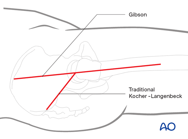 trochanter osteotomy