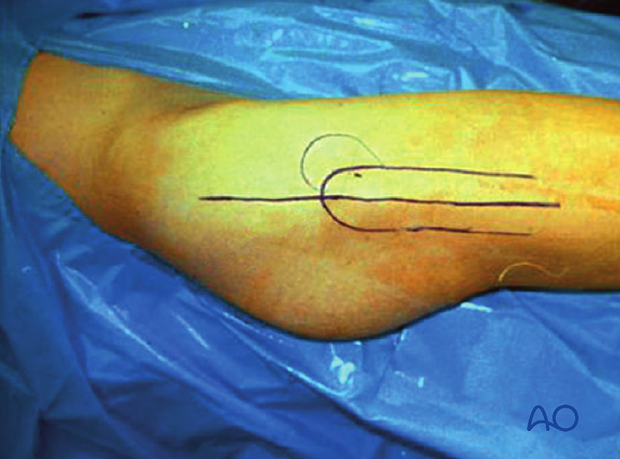 With the hip in a neutral rotation position, a long straight lateral incision is made (modified Gibson variation).