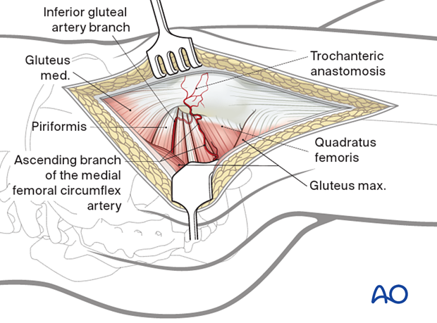 The trochanteric anastomosis communicates with the ascending branch of the medial femoral circumflex artery at the cranial border of the quadratus femoris. The second landmark is provided by the superior inferior gluteal artery branch.