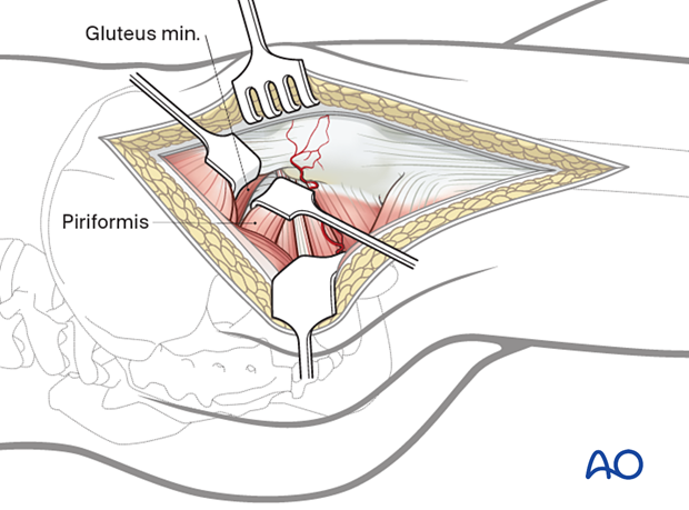 The interval between the piriformis and gluteus minimus is developed.