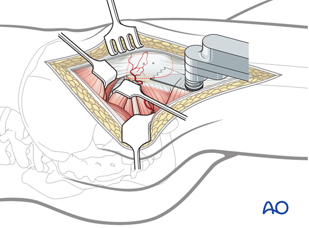 The osteotomy is carried out from the tip of the trochanter to the base of the vastus tubercle using a saline-cooled oscillating saw.