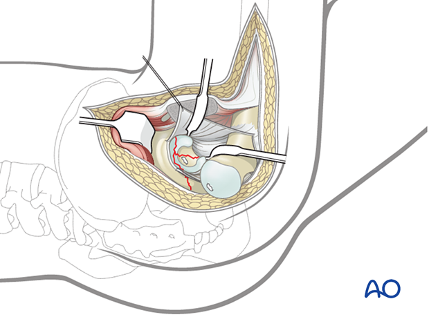 The anterior limb of the T-shaped fracture can be visualized and the reduction assessed.