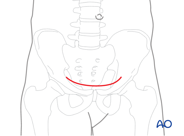 modified stoppa approach