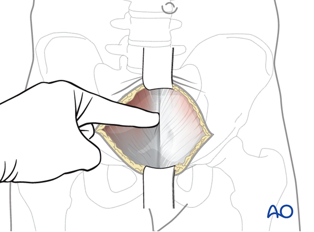 modified stoppa approach