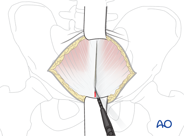 modified stoppa approach