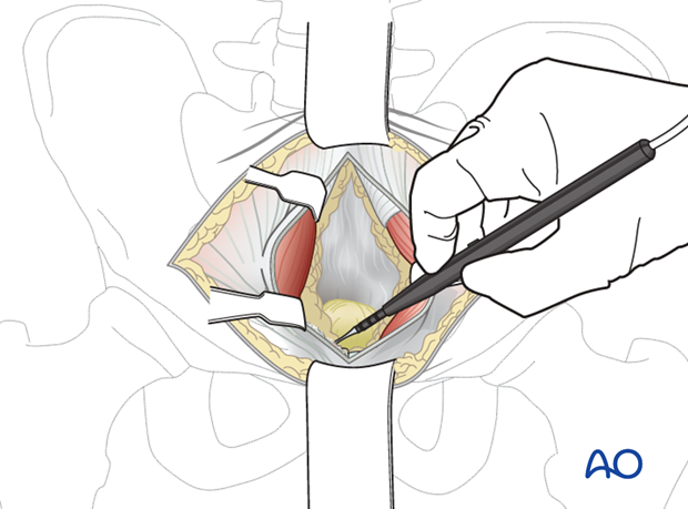 modified stoppa approach