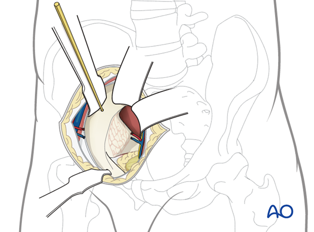 modified stoppa approach