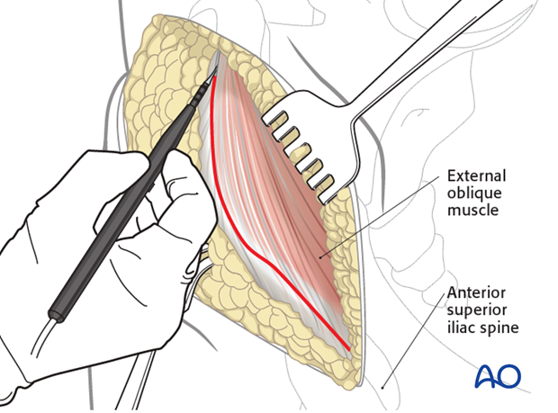 modified stoppa approach