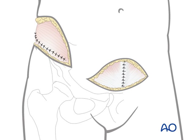 modified stoppa approach