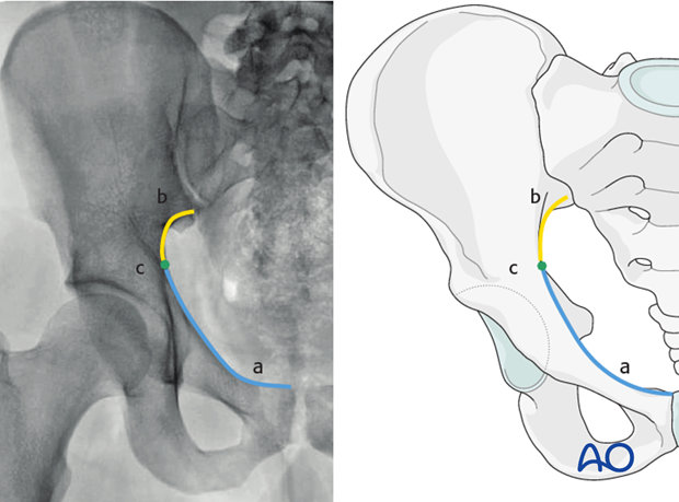 radiology of the intact acetabulum