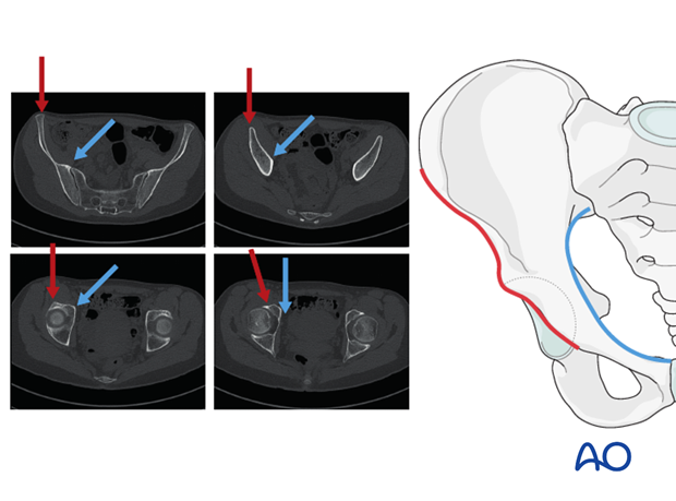 radiology of the intact acetabulum