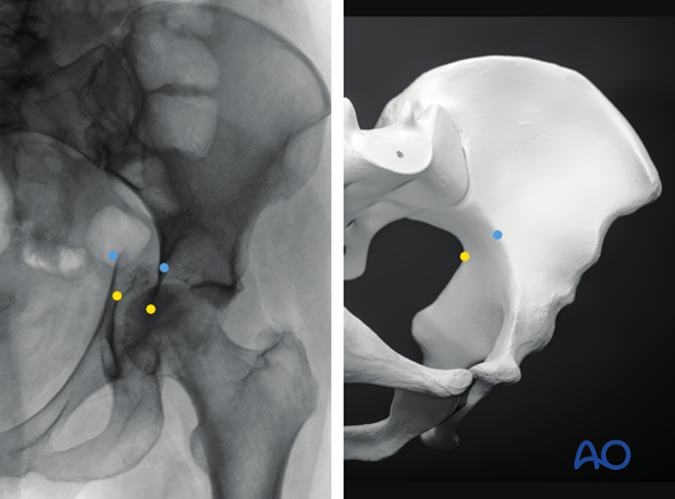 radiology of the intact acetabulum