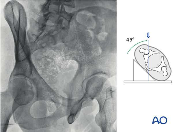 radiology of the intact acetabulum