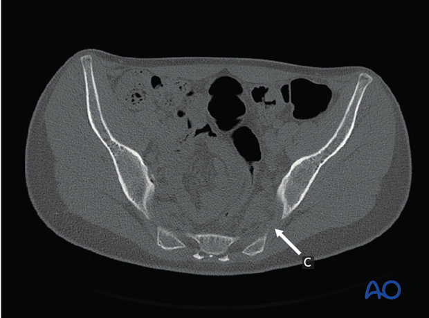 radiology of the intact acetabulum