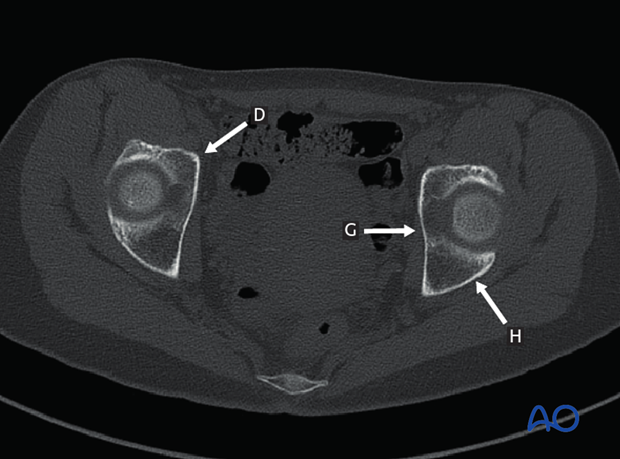 radiology of the intact acetabulum