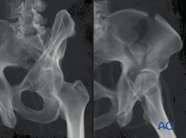 radiology of the intact acetabulum