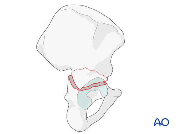 radiology of the intact acetabulum