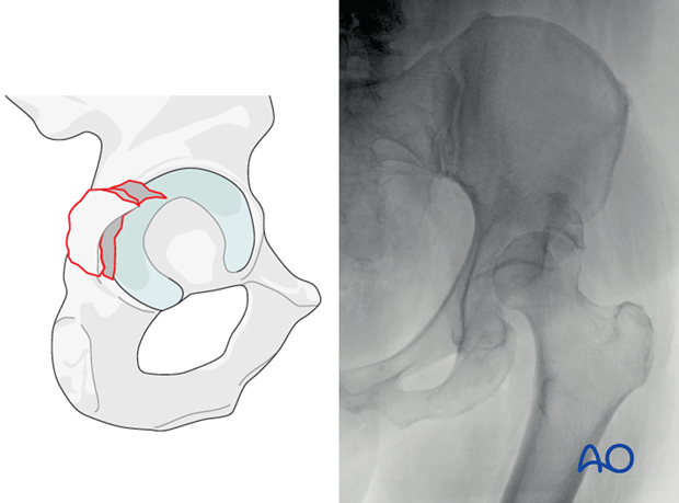 characteristics of elemental fracture types