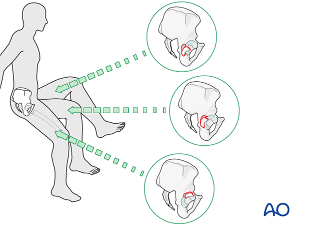 characteristics of elemental fracture types