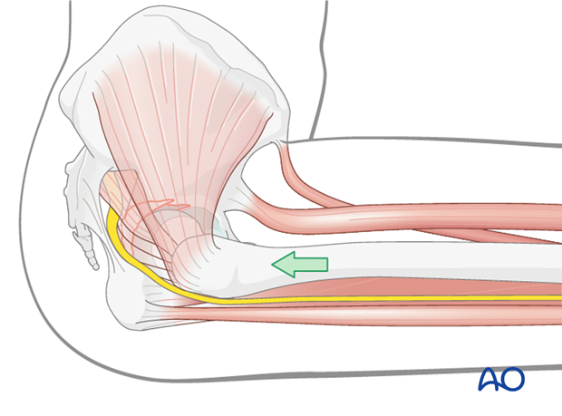 characteristics of associated fracture types