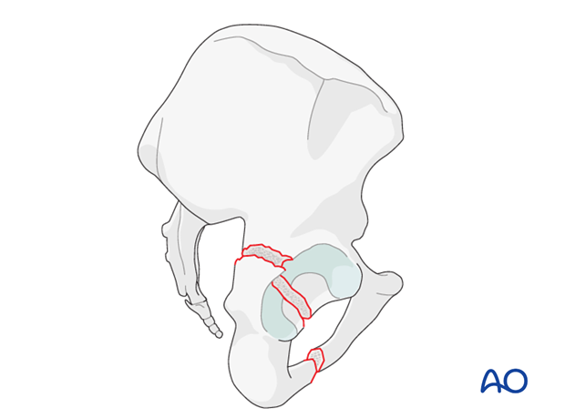 characteristics of elemental fracture types