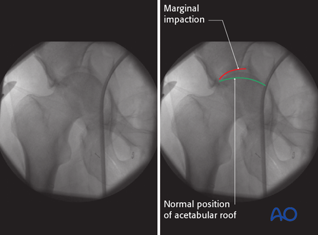 characteristics of elemental fracture types