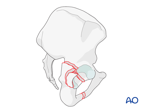 characteristics of associated fracture types