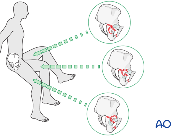 characteristics of associated fracture types