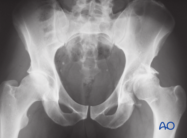 characteristics of associated fracture types