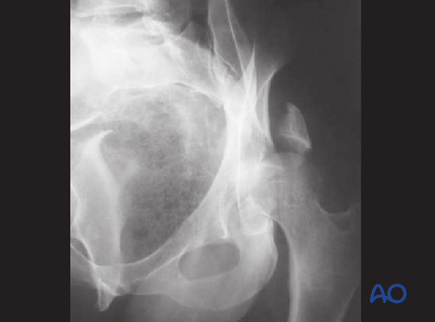 characteristics of associated fracture types