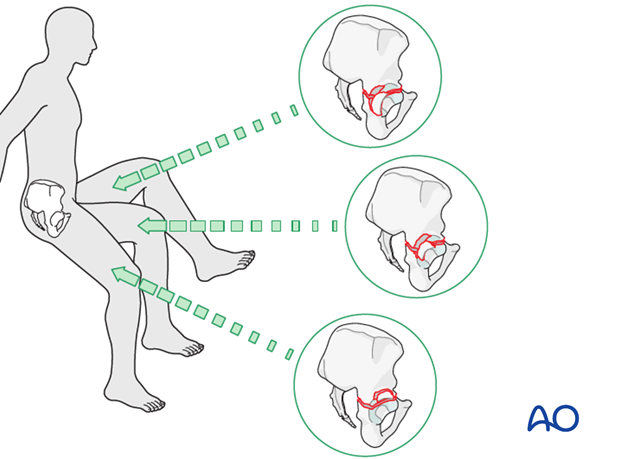 characteristics of associated fracture types