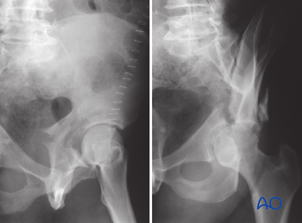 characteristics of associated fracture types