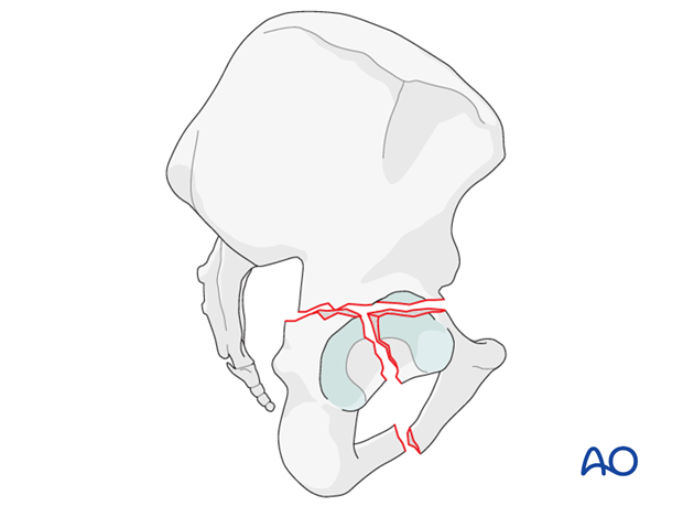 radiology of the intact acetabulum