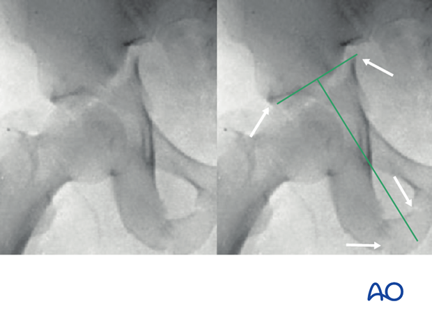 characteristics of associated fracture types