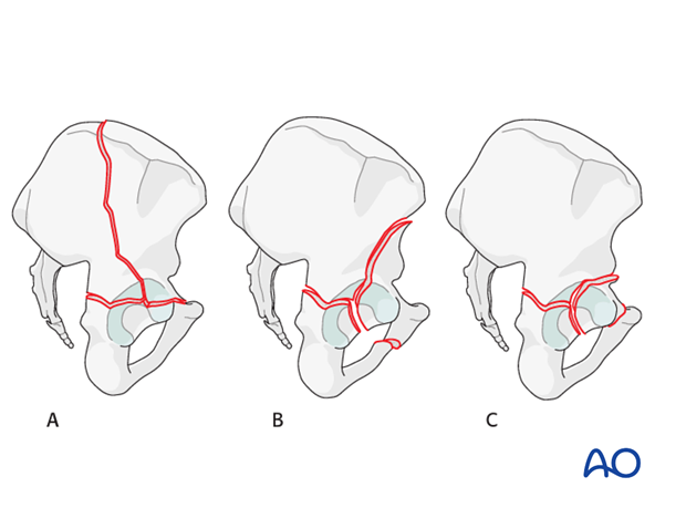 characteristics of associated fracture types