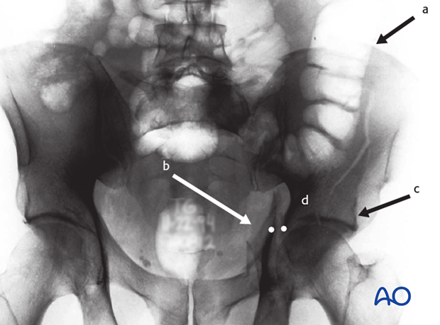 characteristics of associated fracture types