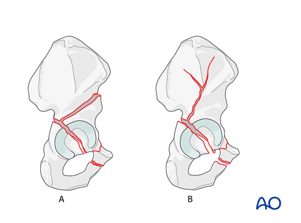 characteristics of associated fracture types