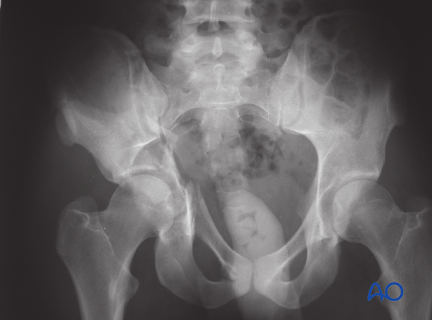 characteristics of associated fracture types