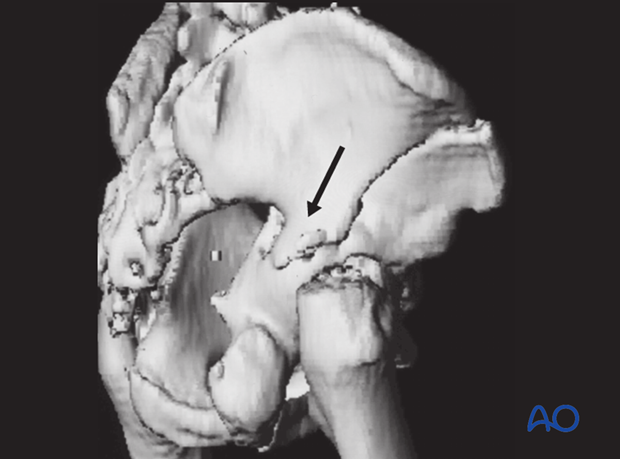 characteristics of associated fracture types