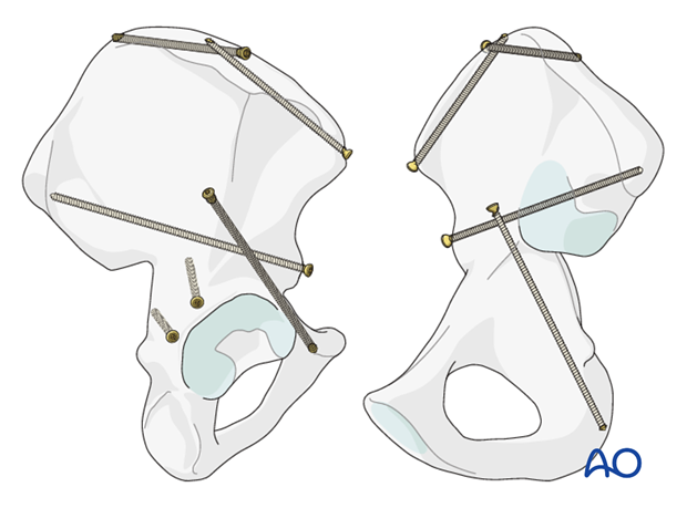 general stabilization principles and screw directions