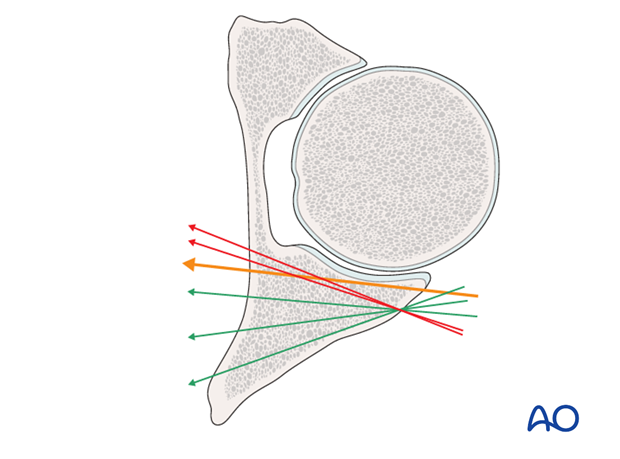 general stabilization principles and screw directions