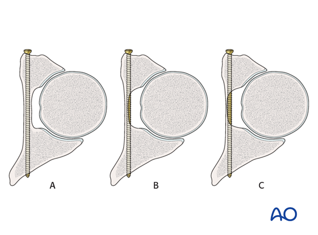 general stabilization principles and screw directions