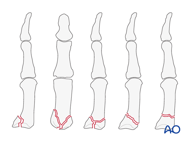 This approach is indicated for intraarticular fractures of the first carpo-metacarpal joint, such as the Bennett, ...